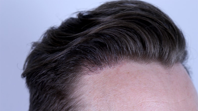 Hair implant afters