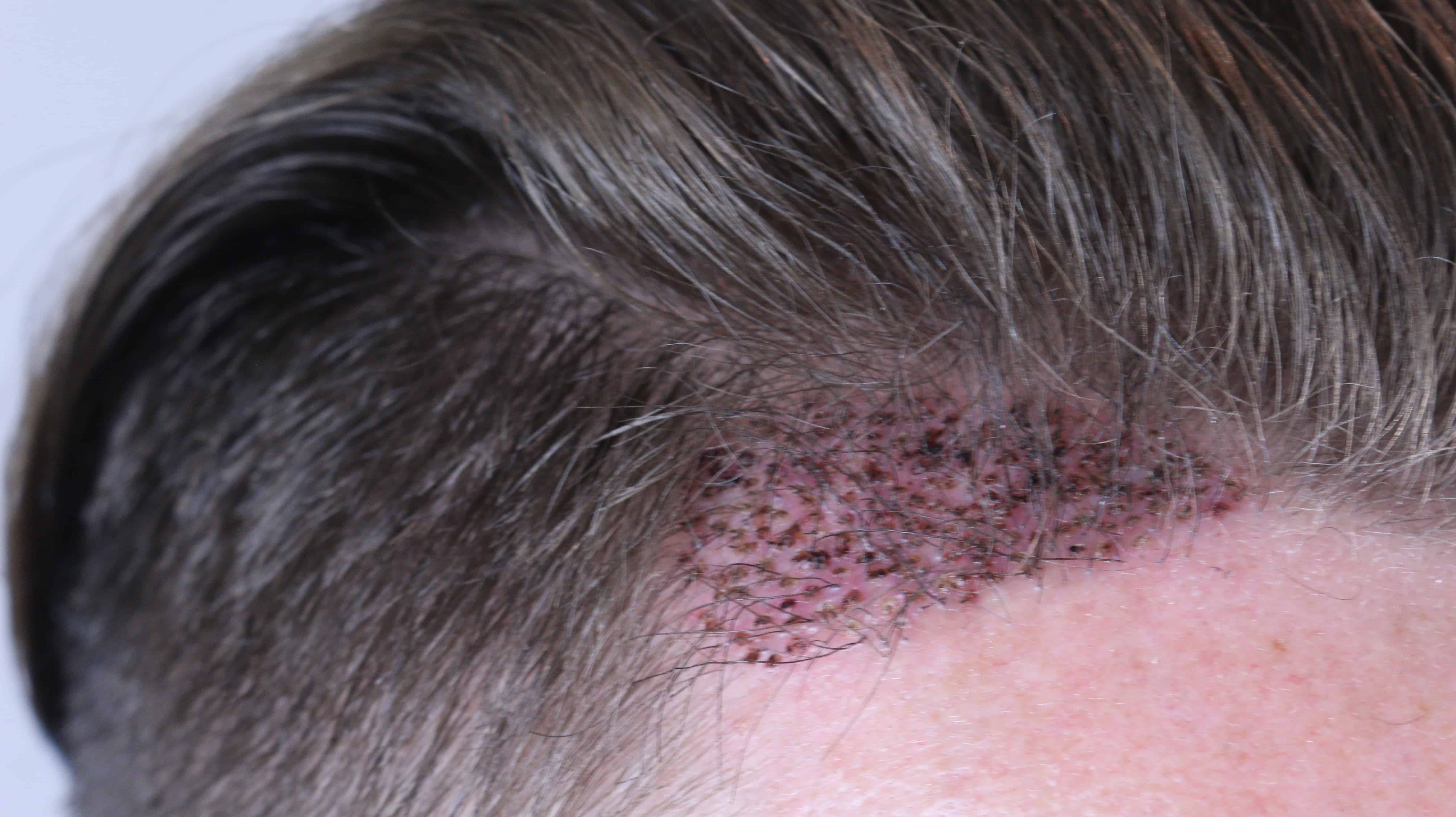 Hair Implant hair loss solutions for men