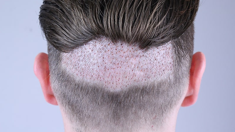 Hair implant sample spot