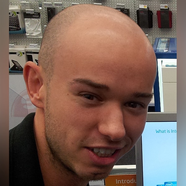 Micro pigmentation hair loss solutions for men