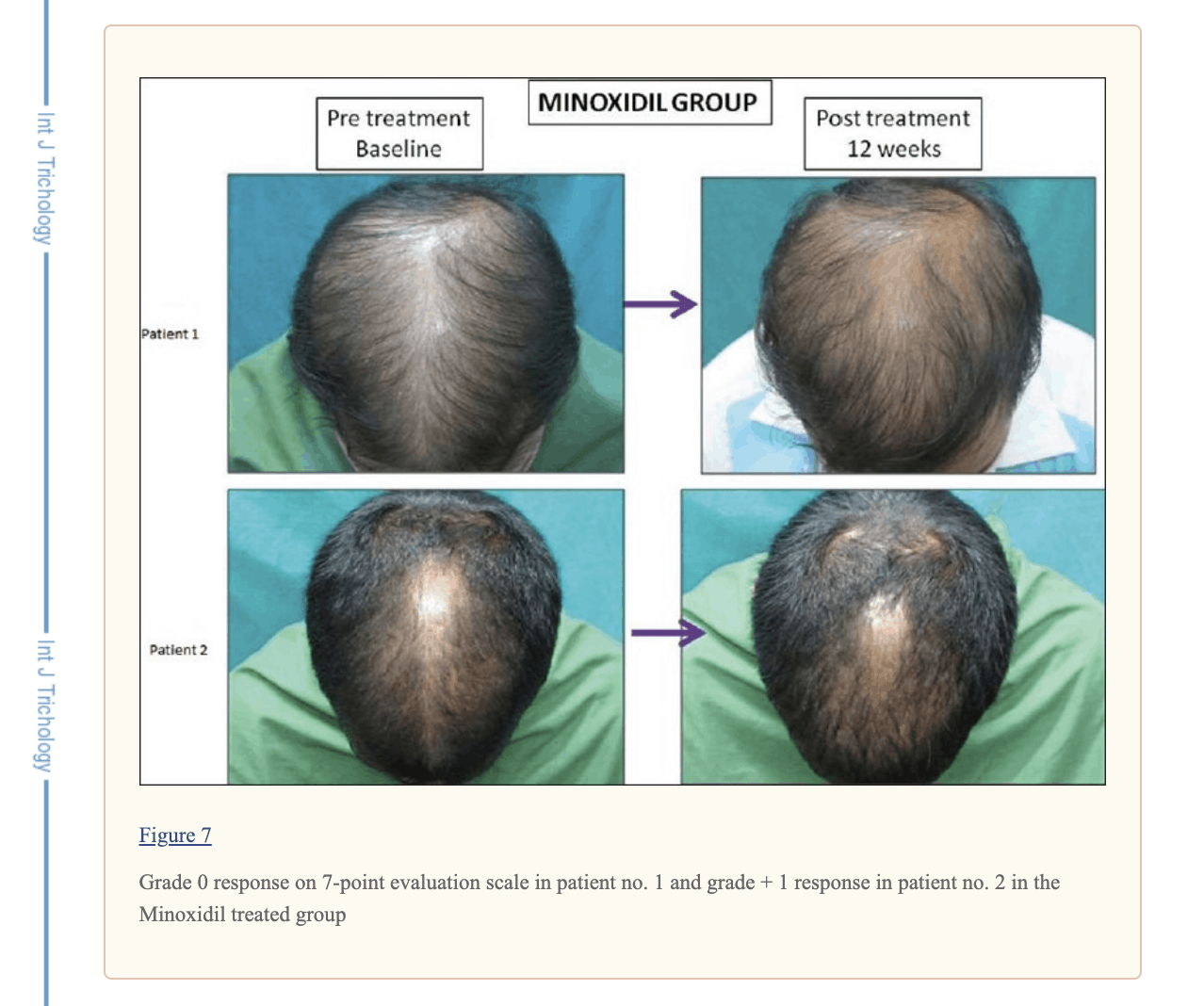 Group 1 - Minoxodil with No Beard Roller