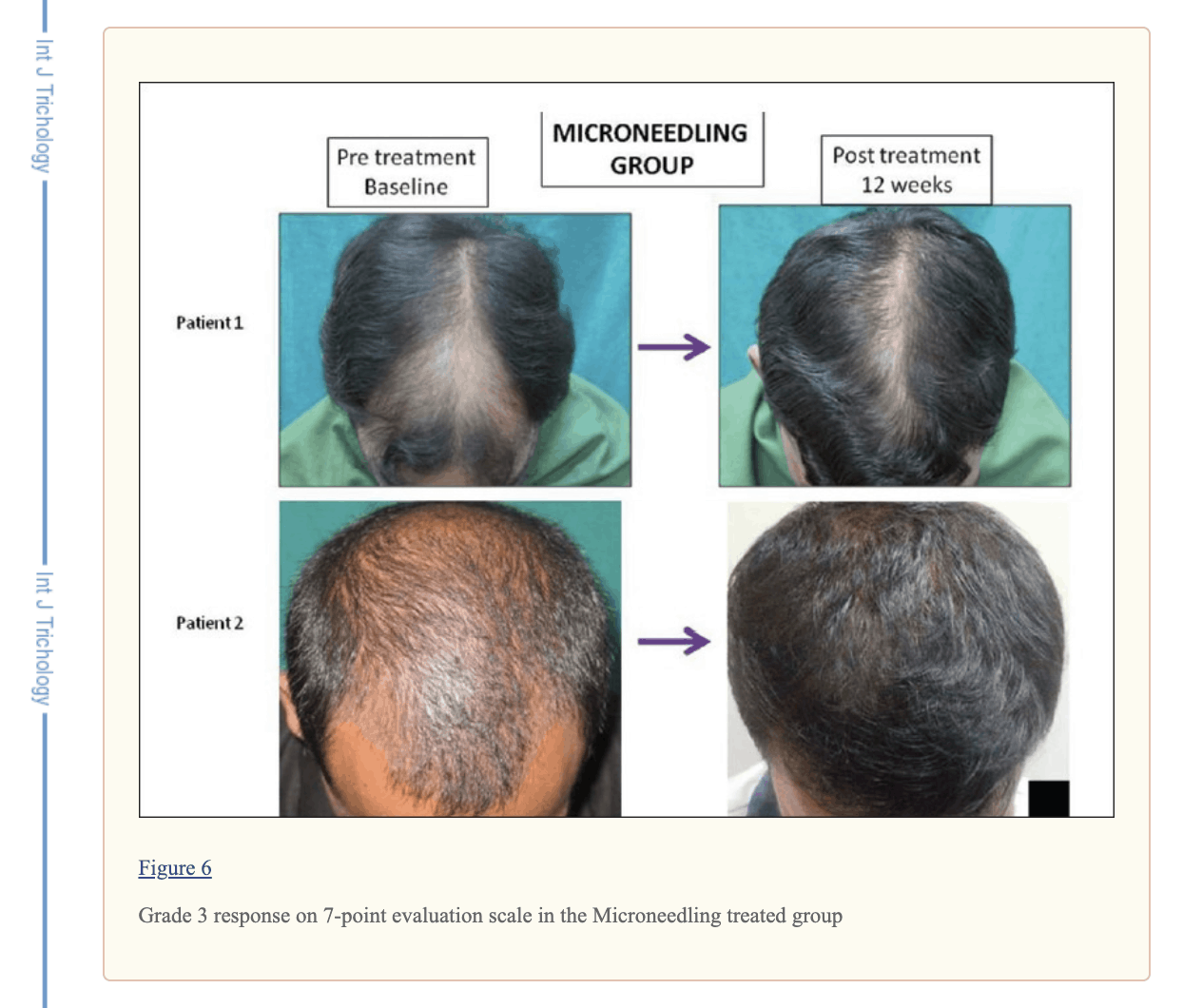 Group 1 - Minoxodil with No Beard Roller